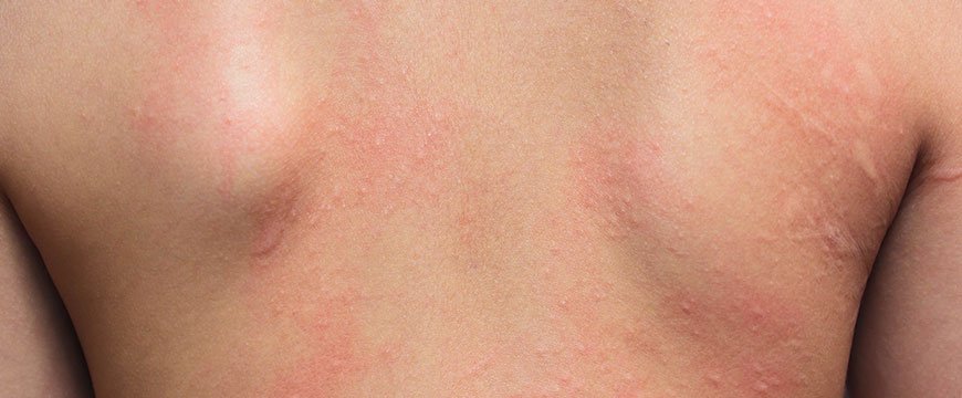 Home Remedies To Relieve Hives And Skin Allergy During Pregnancy